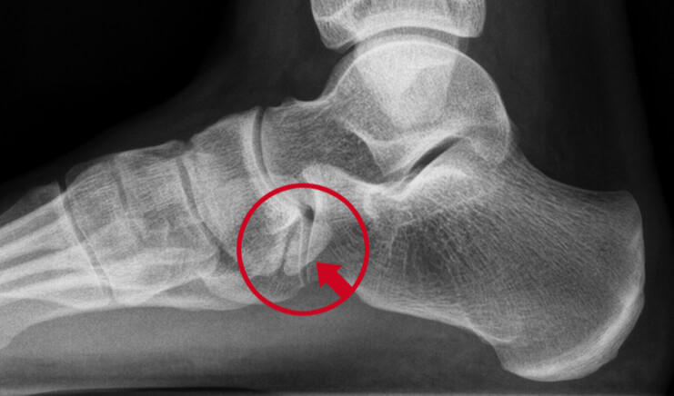 Röntgenfoto vanaf de zijkant van de voet