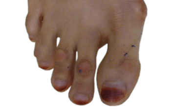 Bermad voorzetsel Bloody Eelt op bovenkant van teen (zonder kromme tenen) - Operatieve behandelingen  - Pijnlijk eelt op de voet - Dr. van Dalen