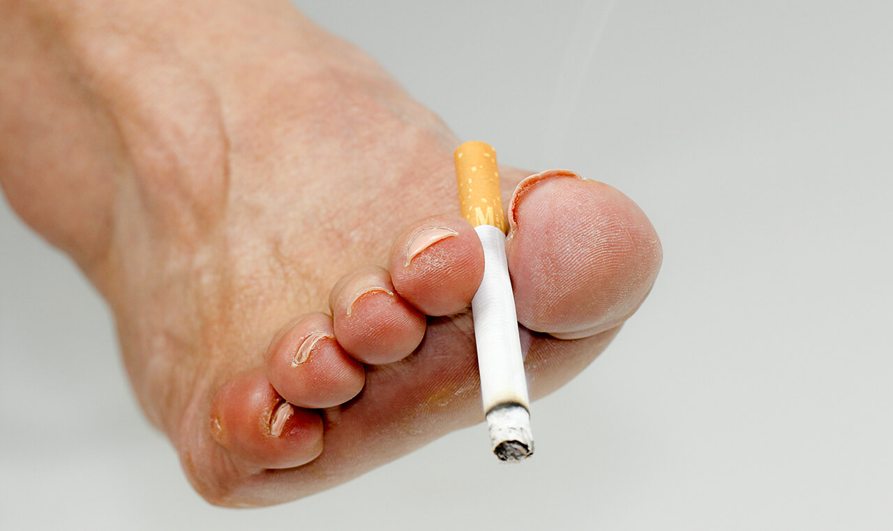 Transformator warmte Moeras Roken - Oorzaken - Pijnlijk eelt op de voet - Dr. van Dalen