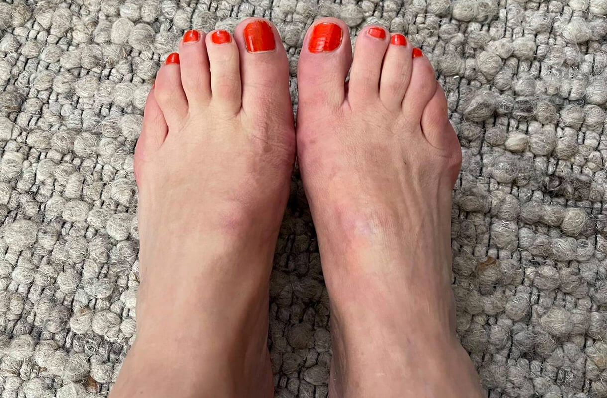De voeten van Jolanda na de operatie