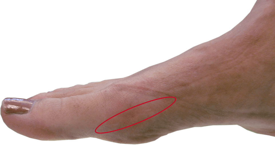 Voorbeeld van een litteken van een open hallux valgus correctie