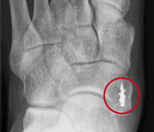 Operatieve behandelmogelijkheden van een pijnlijke bult aan de binnenkant van de voet