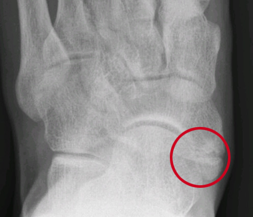 Operatieve behandelmogelijkheden van een pijnlijke bult aan de binnenkant van de voet