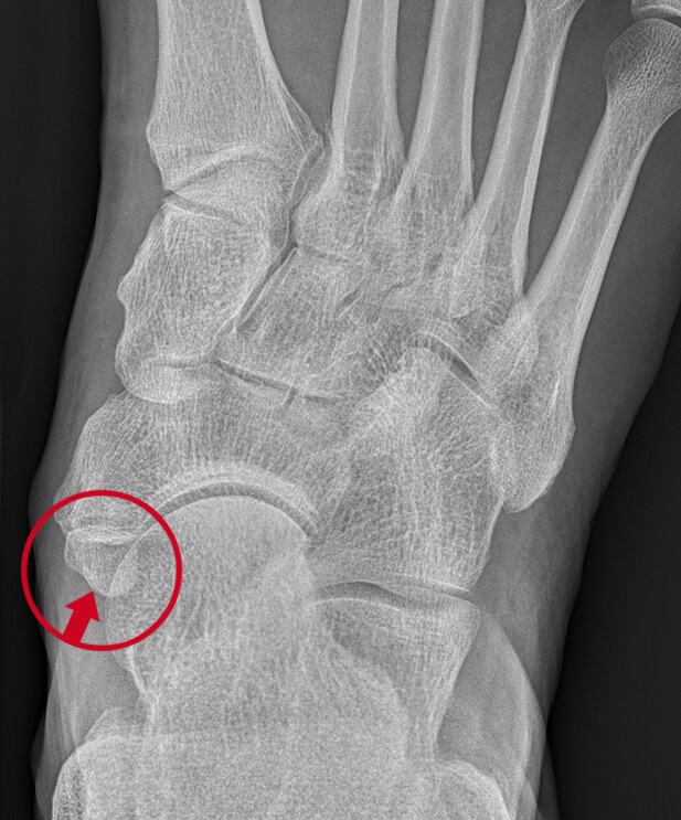 Röntgenfoto van de voet van bovenaf