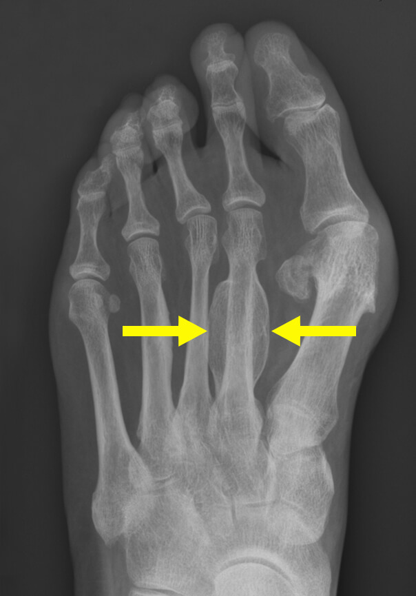 Röntgenfoto van een vermoeidheidsbreuk