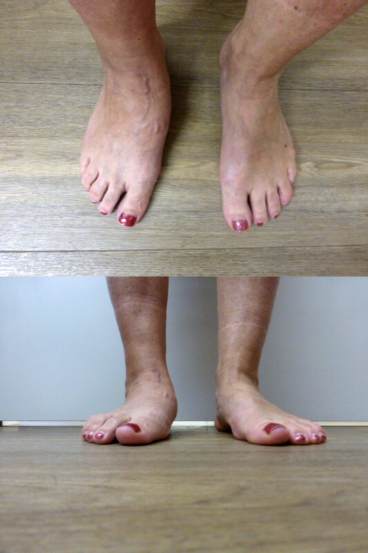vandaag Verbetering straal Artritis - Oorzaken - Dikke voeten en enkels - Dr. van Dalen