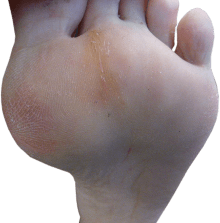 Voorbeeld van eelt onder de voet doordat het eerste middenvoetsbeentje lager staat dan normaal