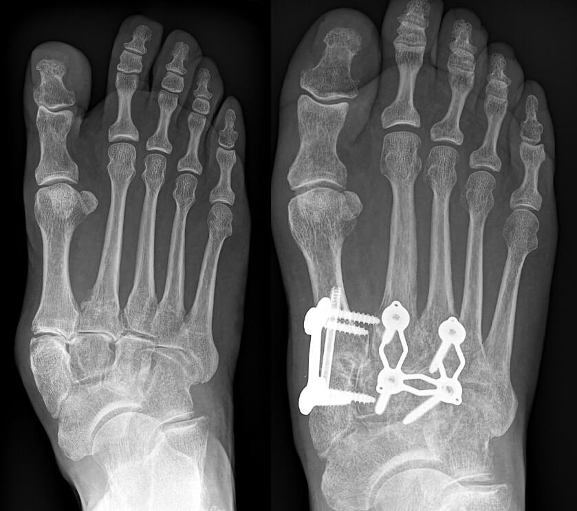 Operatieve behandeling van voetwortelartrose